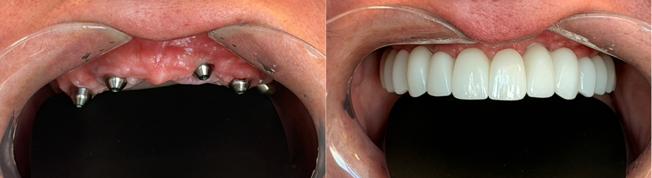 Real patient before and after All-on-6 full-arch dental implants at Neo Implant Dental Group