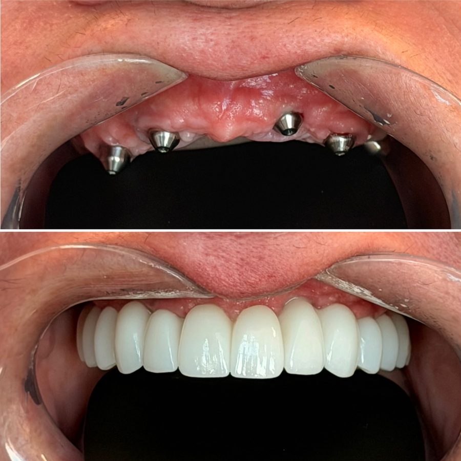Real All-on-6 patient — before and after full-arch restoration