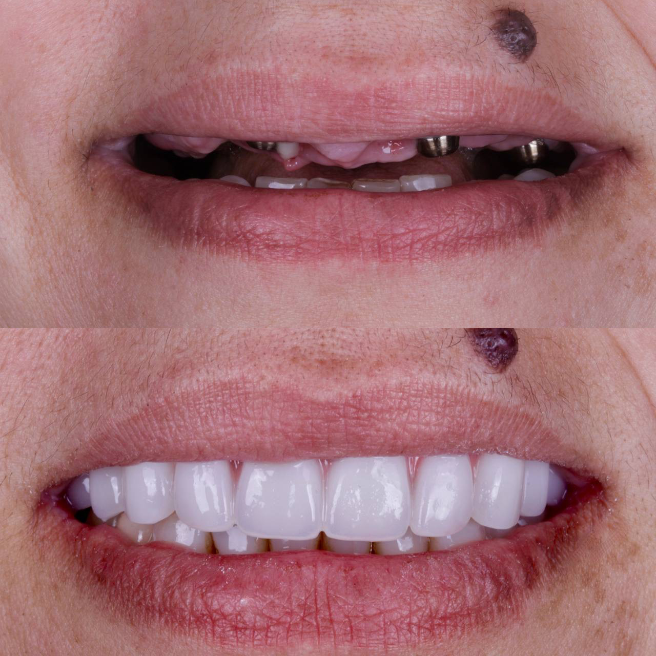 Real All-on-6 patient — before and after full-arch restoration