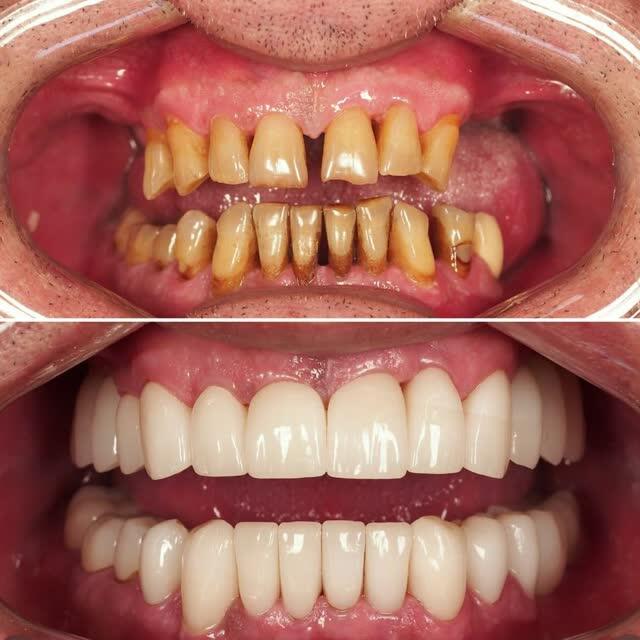 Full mouth restoration results