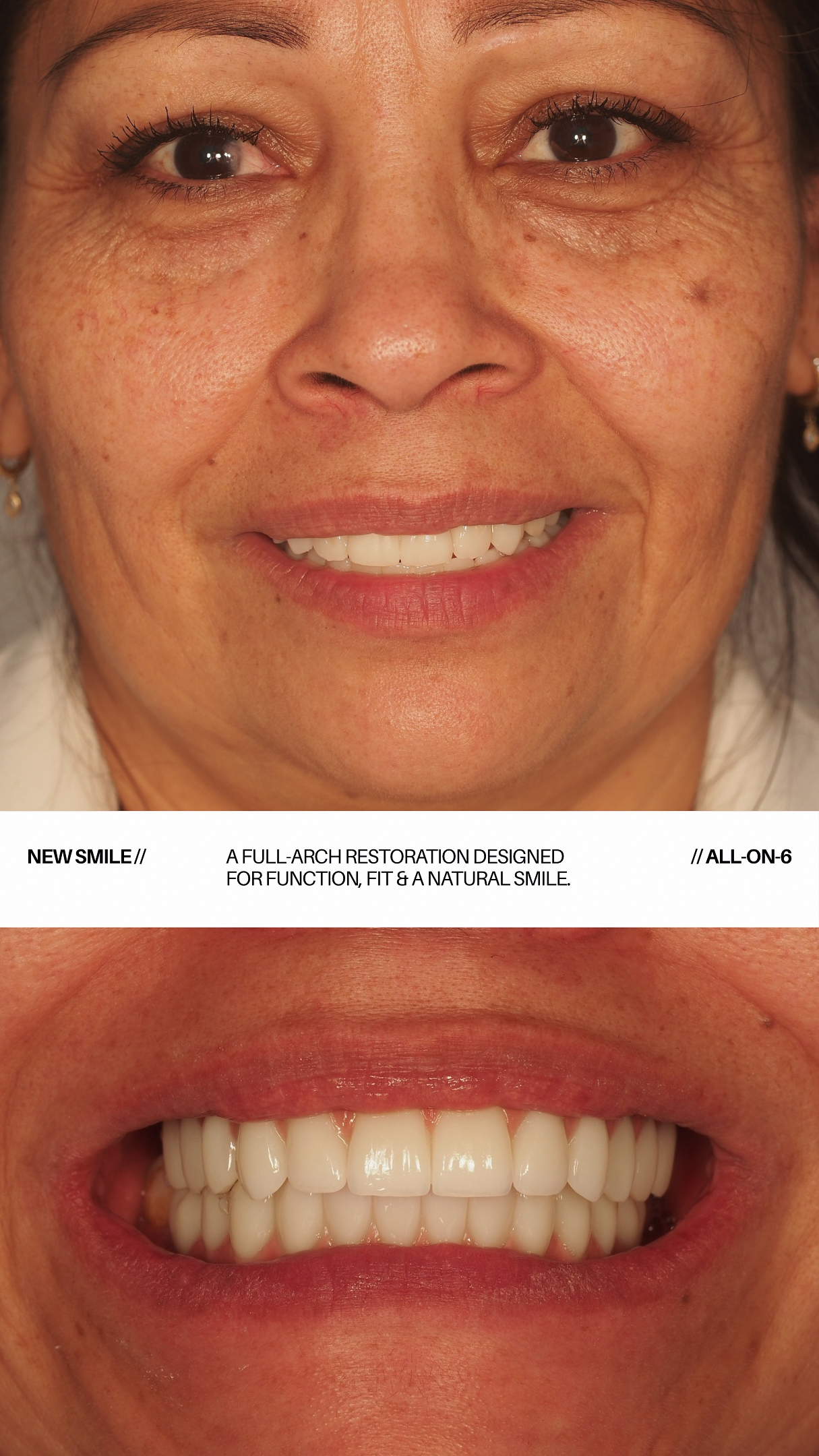 Real patient's new smile after All-on-6 full-arch restoration