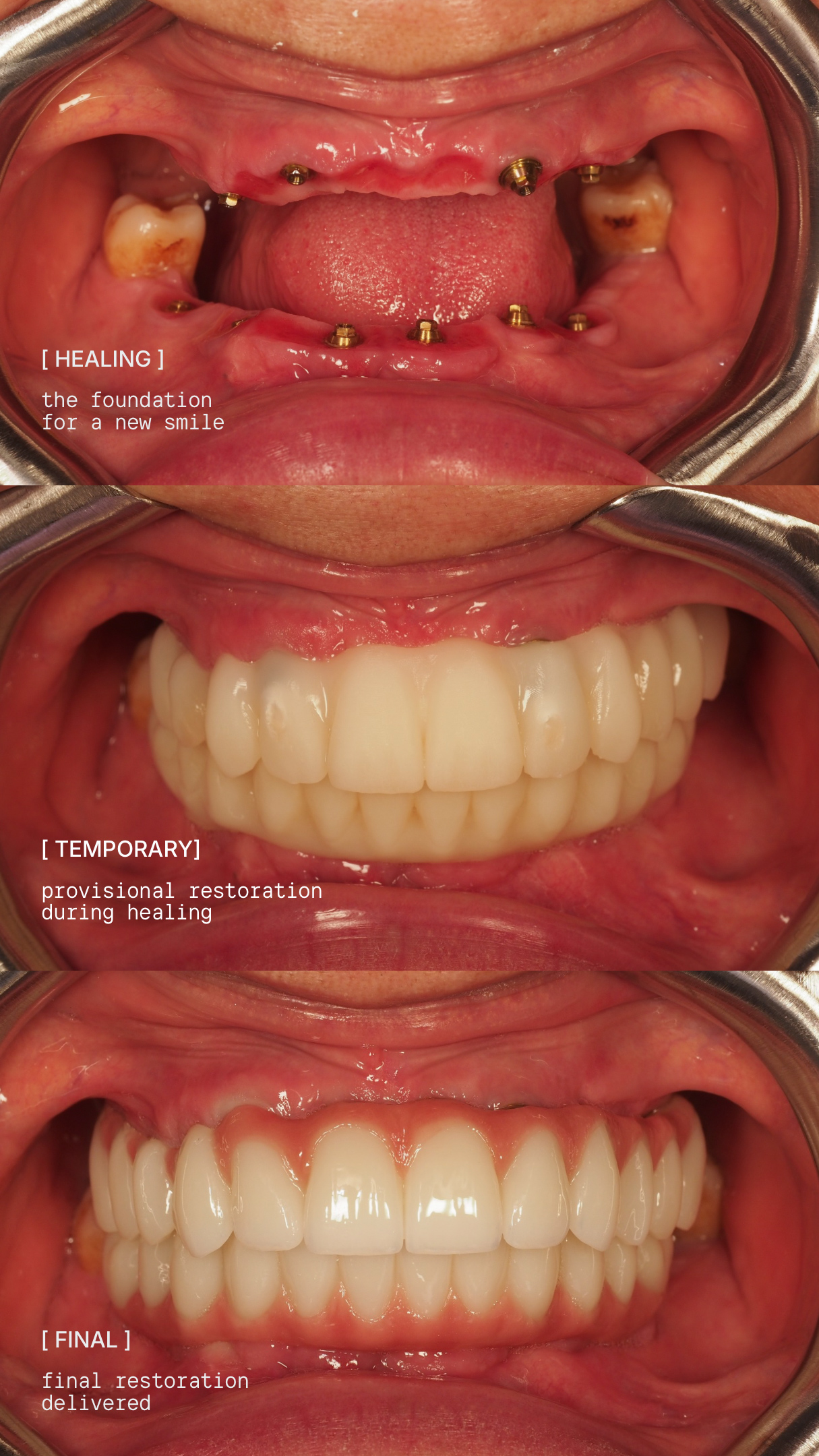 All-on-6 treatment stages: healing implants, temporary teeth, final restoration
